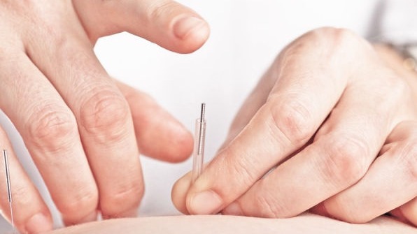 Aplicación de punción seca para tratamiento muscular